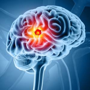 Brain Cancer