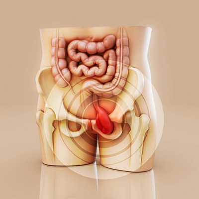 Rectal Cancer Treatment in Vijayawada