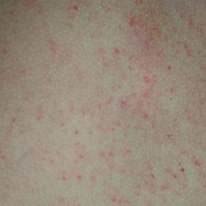 thrombocytopenia